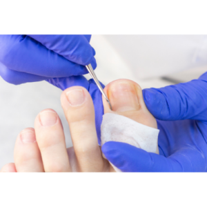 Chiropody - Ingrowing toe nails