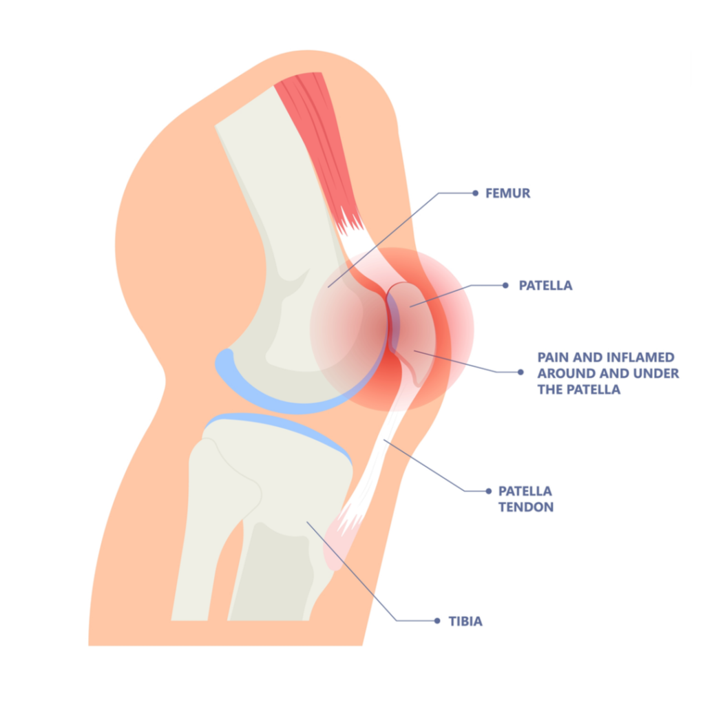 HTC Blog - kneecap diagram (1)