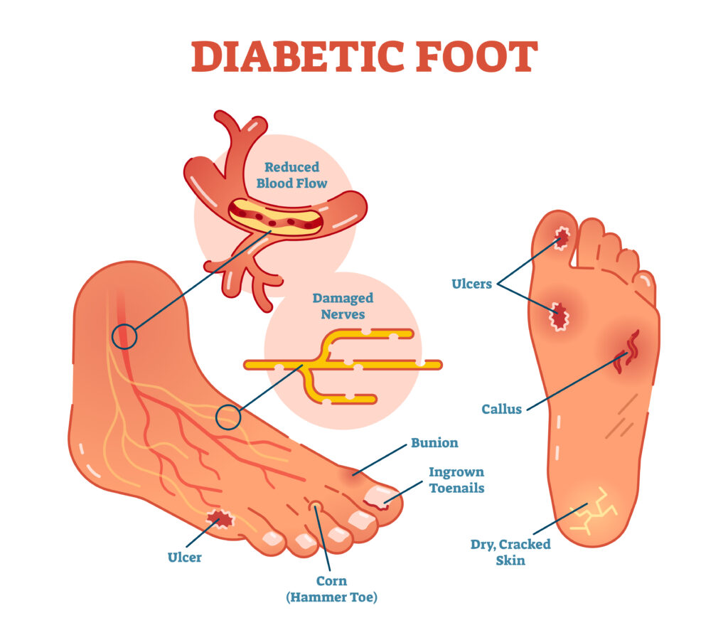 HTC - Blog - Diagram of diabetic foot
