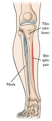 Shin Splints Diagram