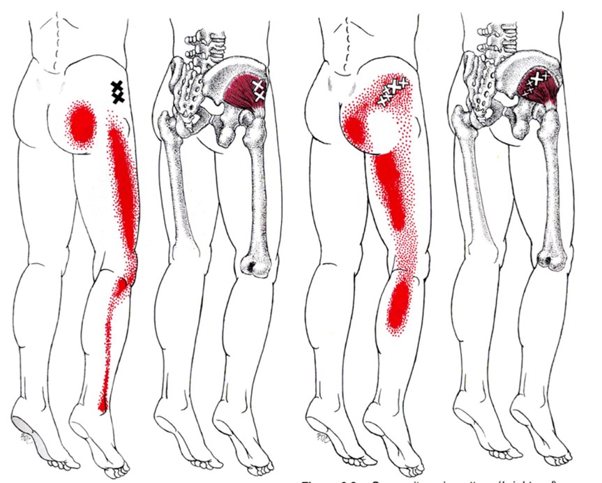 HTC - Blog - Gluteal Tendons