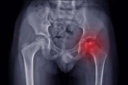 Perthes Disease X-ray